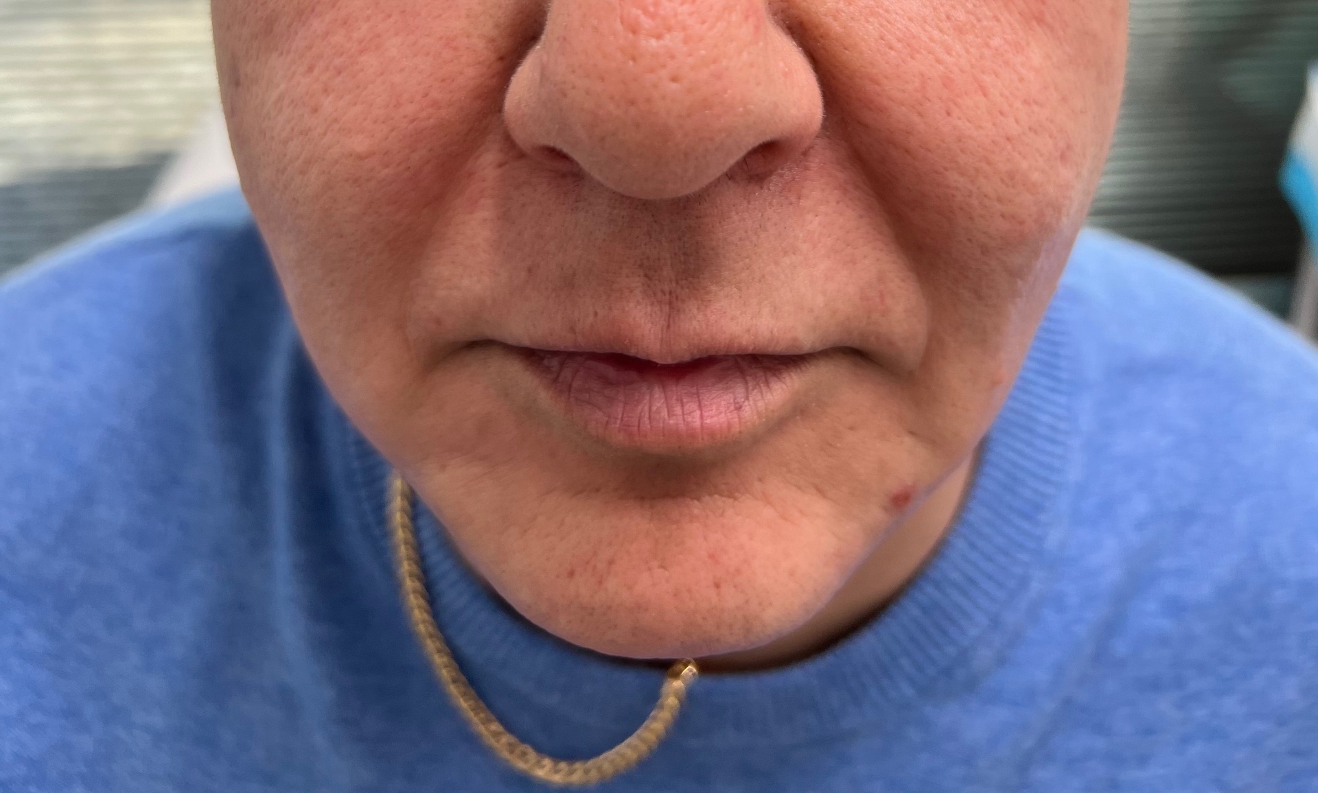 Lip & perioral refresh — before
