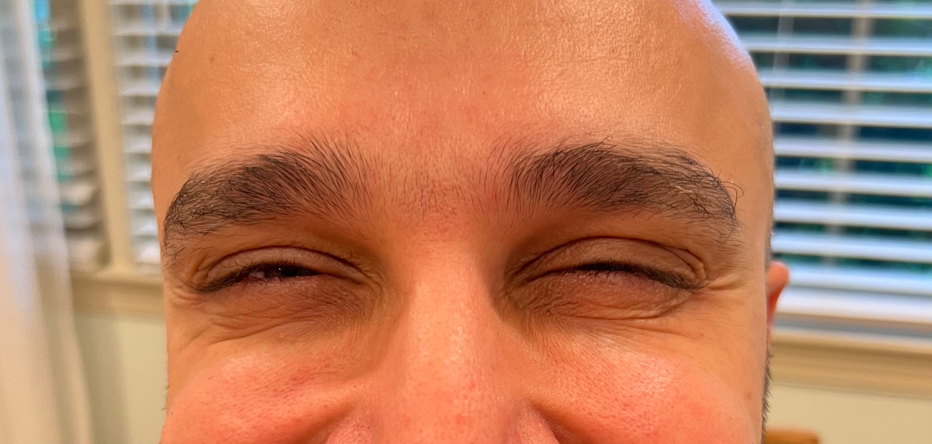 Botox · Glabellar 11s — after