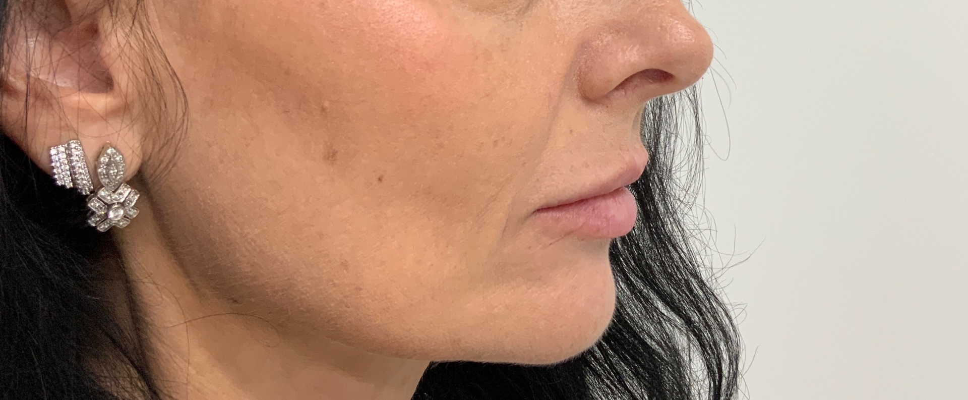 Lip filler · 0.75ml — before
