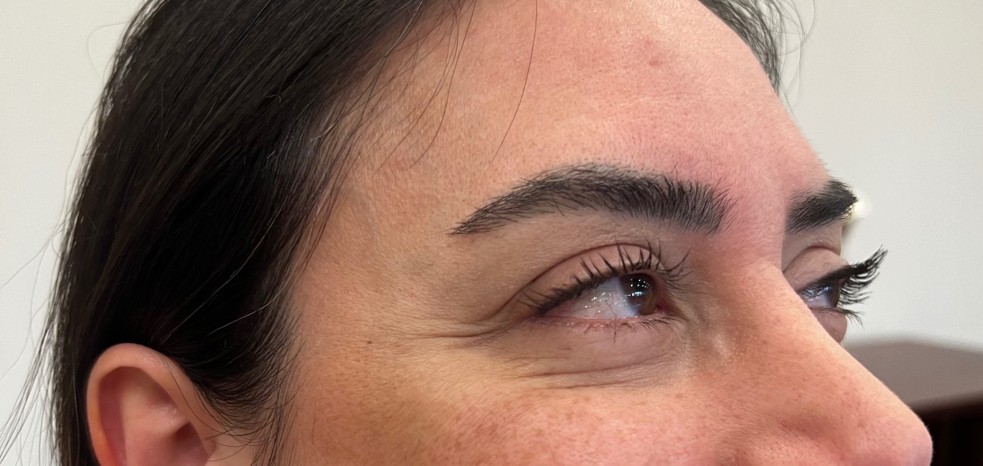 Botox · Crow's feet — before