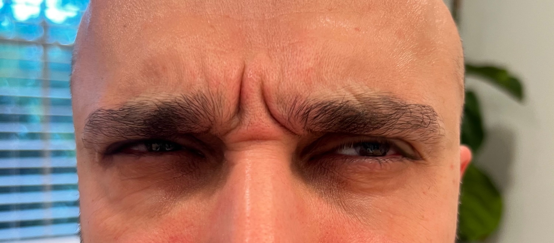 Botox · Glabellar 11s — before