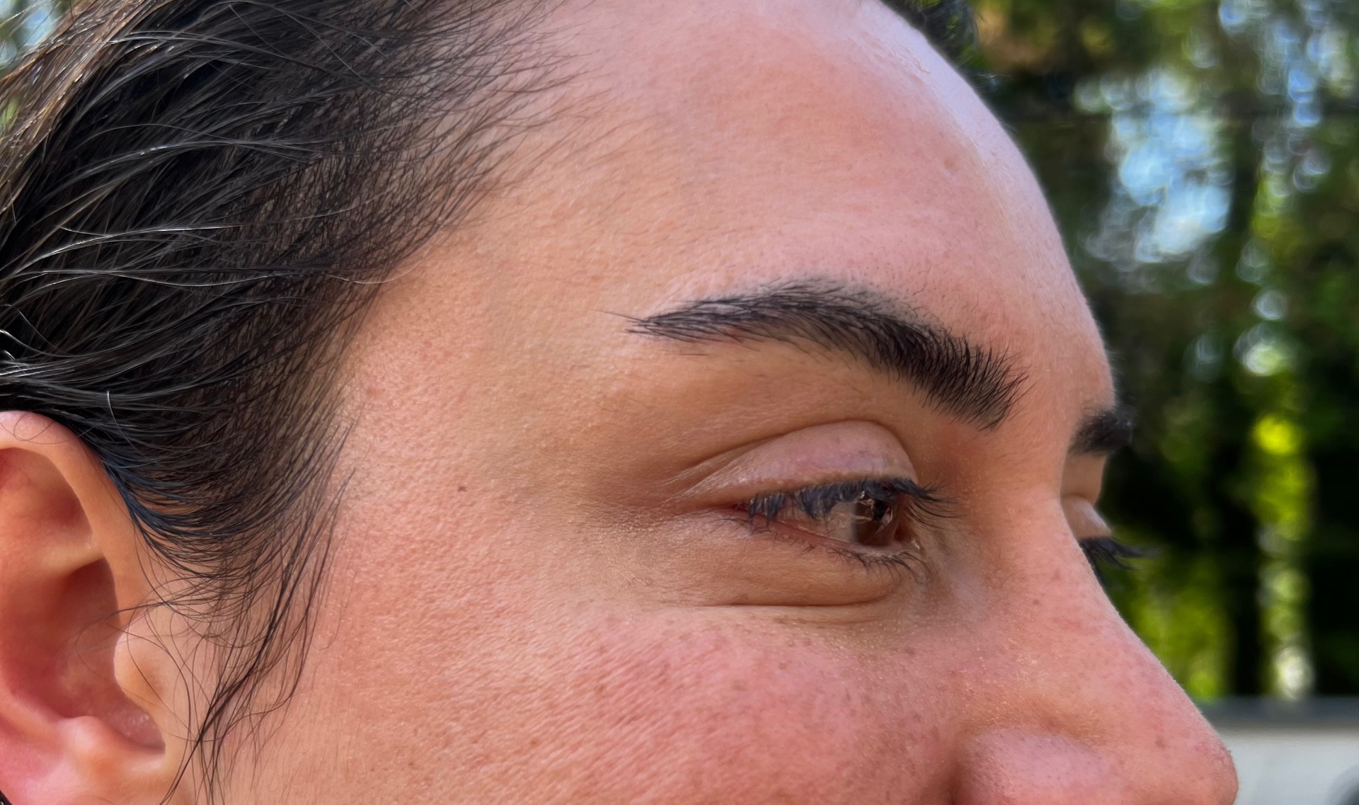 Botox · Crow's feet — after
