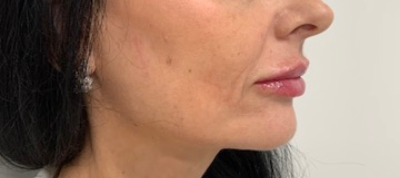 Lip filler · 0.75ml — after