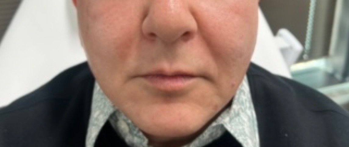 Lip & perioral refresh — after